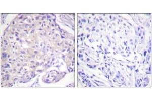 Immunohistochemistry analysis of paraffin-embedded human breast carcinoma, using PAK1 (Phospho-Thr212) Antibody. (PAK1 Antikörper  (pThr212))