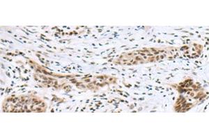Immunohistochemistry of paraffin-embedded Human esophagus cancer tissue using INSM1 Polyclonal Antibody at dilution of 1:50(x200) (INSM1 Antikörper)