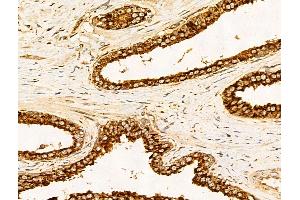 ABIN7094814 and ABIN7098865 at 1/100 staining Human colorectal cancer by IHC-P. (Filaggrin Antikörper  (C-Term))