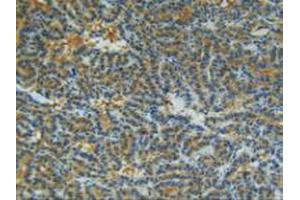 IHC-P analysis of Human Thyroid Tissue, with DAB staining. (MMP13 Antikörper  (AA 103-290))