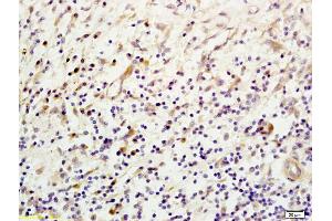 Formalin-fixed and paraffin embedded human esophageal carcinoma labeled with Anti- Mannan Binding Lectin Polyclonal Antibody, Unconjugated (ABIN731663) at 1:200, followed by conjugation to the secondary antibody and DAB staining.