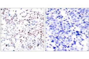 Immunohistochemical analysis of paraffin-embedded human breast carcinoma tissue using Myc(Phospho-Thr358) Antibody(left) or the same antibody preincubated with blocking peptide(right). (c-MYC Antikörper  (pThr358))