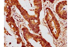 IHC image of nme1HU diluted at 1:10 and staining in paraffin-embedded human colon cancer performed on a Leica BondTM system. (Histone H2B Antikörper  (AA 9-20))