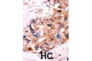 Immunohistochemistry (IHC) image for anti-V-Yes-1 Yamaguchi Sarcoma Viral Oncogene Homolog 1 (YES1) (pTyr530), (pTyr537) antibody (ABIN2970974) (YES1 Antikörper  (pTyr530, pTyr537))