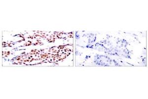 Immunohistochemical analysis of paraffin-embedded human breast carcinoma tissue using JunB (phospho- Ser79) antibody (E011026). (JunB Antikörper  (pSer79))