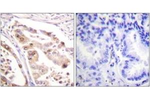 Immunohistochemistry analysis of paraffin-embedded human lung carcinoma tissue, using RFA2 (Ab-21) Antibody. (RPA2 Antikörper  (AA 10-59))