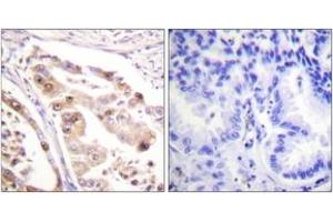 Immunohistochemistry analysis of paraffin-embedded human lung carcinoma tissue, using RFA2 (Ab-21) Antibody.