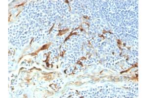 Formalin-fixed, paraffin-embedded human endometrial carcinoma stained with Biotin-conjugated Mesothelin Mouse Monoclonal Antibody (MSLN/2131).