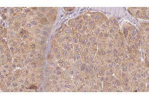 ABIN6277526 at 1/100 staining Human Melanoma tissue by IHC-P. (BPI Antikörper  (Internal Region))