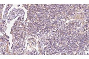 ABIN6273167 at 1/100 staining Human lymph cancer tissue by IHC-P. (SRP14 Antikörper  (Internal Region))