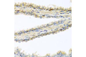 Immunohistochemistry of paraffin-embedded human prostate using GPLD1 antibody (ABIN5973975) at dilution of 1/100 (40x lens). (GPLD1 Antikörper)
