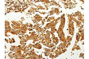 The image on the left is immunohistochemistry of paraffin-embedded Human gastric cancer tissue using ABIN7190727(FZD6 Antibody) at dilution 1/60, on the right is treated with synthetic peptide. (FZD6 Antikörper)