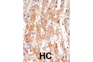 Formalin-fixed and paraffin-embedded human cancer tissue reacted with the primary antibody, which was peroxidase-conjugated to the secondary antibody, followed by DAB staining. (MAP3K6 Antikörper  (C-Term))