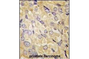 Formalin-fixed and paraffin-embedded human prostata carcinoma tissue reacted with FZD1 antibody (Center) (ABIN389236 and ABIN2839386) , which was peroxidase-conjugated to the secondary antibody, followed by DAB staining.