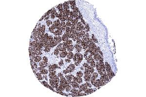 Strong membranous CD56 staining in a neuroendocrine tumor of the lung (Rekombinanter CD56 Antikörper)
