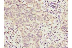 Immunohistochemistry of paraffin-embedded human bladder cancer using ABIN7155761 at dilution of 1:100 (HOXD1 Antikörper  (AA 1-240))