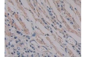 Detection of PKIb in Human Stomach cancer Tissue using Polyclonal Antibody to Protein Kinase Inhibitor Beta (PKIb)