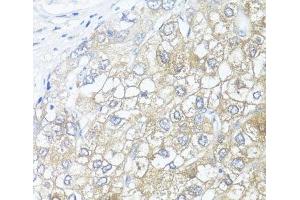 Immunohistochemistry of paraffin-embedded Human liver cancer using ASL Polyclonal Antibody at dilution of 1:100 (40x lens). (ASL Antikörper)