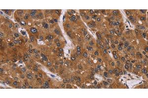 Immunohistochemistry of paraffin-embedded Human liver cancer using PPIB Polyclonal Antibody at dilution of 1:45 (PPIB Antikörper)