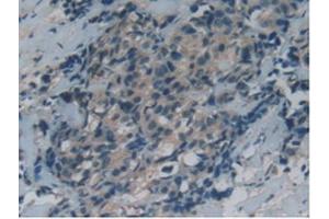 IHC-P analysis of Human Thyroid Cancer Tissue, with DAB staining. (GAS6 Antikörper  (AA 136-311))