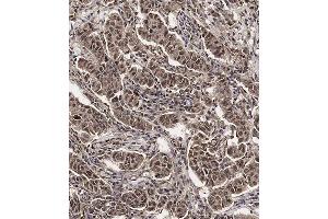 Immunohistochemical analysis of (ABIN654398 and ABIN2844139) on paraffin-embedded Human breast carcinoma tissue. (SCXA Antikörper  (C-Term))