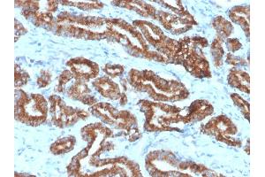 Formalin-fixed, paraffin-embedded human prostate carcinoma (10X) stained with AMACR / p504S Rabbit Monoclonal Antibody (13H4) (AMACR Antikörper)