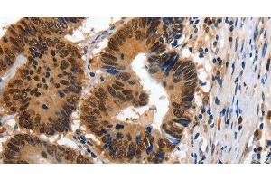 Immunohistochemistry of paraffin-embedded Human colon cancer using 14-3-3 epsilon Polyclonal Antibody at dilution of 1:100 (YWHAE Antikörper)