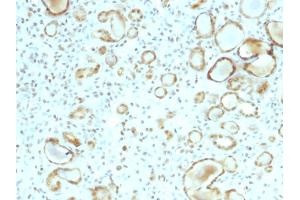 Immunohistochemistry (IHC) image for anti-Signal Transducer and Activator of Transcription 6, Interleukin-4 Induced (STAT6) antibody (ABIN6940672)