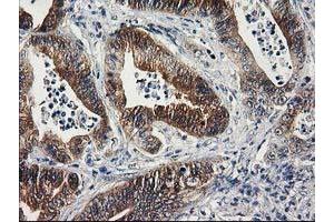 Immunohistochemical staining of paraffin-embedded Adenocarcinoma of Human colon tissue using anti-SULT1C2 mouse monoclonal antibody. (SULT1C2 Antikörper)