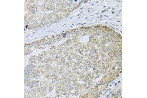 Immunohistochemistry of paraffin-embedded human liver cancer using ANAPC10 antibody at dilution of 1:100 (x40 lens). (ANAPC10 Antikörper)