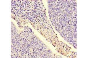 Immunohistochemistry of paraffin-embedded human cervical cancer using ABIN7169007 at dilution of 1:100