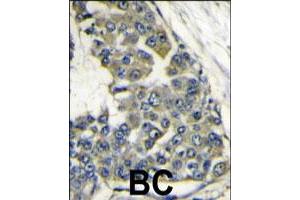 Formalin-fixed and paraffin-embedded human breast carcinoma reacted with EIF4B polyclonal antibody  , which was peroxidase-conjugated to the secondary antibody, followed by DAB staining. (EIF4B Antikörper  (Internal Region))