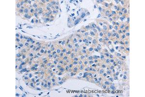 Immunohistochemistry of Human lung cancer using HOXA6 Polyclonal Antibody at dilution of 1:60 (HOXA6 Antikörper)