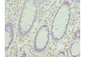 Immunohistochemistry of paraffin-embedded human colon cancer using ABIN7157478 at dilution of 1:100 (KHDRBS2 Antikörper  (AA 1-349))