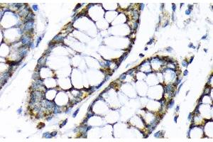 Immunohistochemistry of paraffin-embedded Human colon using HK2 Polyclonal Antibody at dilution of 1:200 (40x lens). (Hexokinase 2 Antikörper)