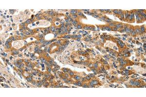 Immunohistochemistry of paraffin-embedded Human gasrtic cancer tissue using ANGPTL1 Polyclonal Antibody at dilution 1:40 (ANGPTL1 Antikörper)