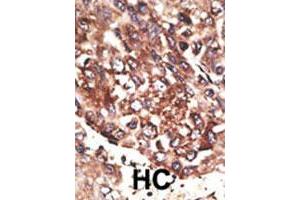 Formalin-fixed and paraffin-embedded human hepatocellular carcinoma tissue reacted with MMP13 polyclonal antibody , which was peroxidase-conjugated to the secondary antibody, followed by AEC staining. (MMP13 Antikörper  (C-Term))