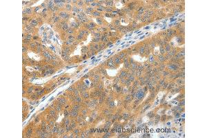 Immunohistochemistry of Human gastric cancer using SCN9A Polyclonal Antibody at dilution of 1:40 (SCN9A Antikörper)