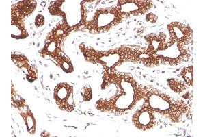 Formalin-fixed, paraffin-embedded human Breast Carcinoma stained with Calpastatin Mouse Monoclonal Antibody (CAST/1550). (Calpastatin Antikörper)