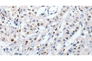 Immunohistochemistry of paraffin-embedded Human lung cancer tissue using HSPA1A Polyclonal Antibody at dilution 1:60 (HSP70 1A Antikörper)