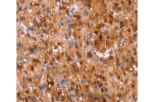 Immunohistochemistry of Human liver cancer using GH1 Polyclonal Antibody at dilution of 1:40 (Growth Hormone 1 Antikörper)