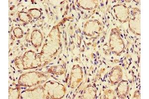 Immunohistochemistry of paraffin-embedded human gastric cancer using ABIN7153609 at dilution of 1:100 (GJB2 Antikörper  (AA 99-131))
