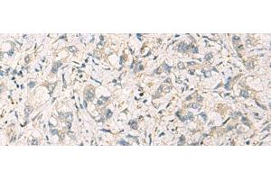 Immunohistochemistry of paraffin-embedded Human liver cancer tissue using STX6 Polyclonal Antibody at dilution of 1:60(x200) (Syntaxin 6 Antikörper)