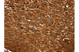 The image on the left is immunohistochemistry of paraffin-embedded Human esophagus cancer tissue using ABIN7192748(TCEB3B Antibody) at dilution 1/25, on the right is treated with synthetic peptide.