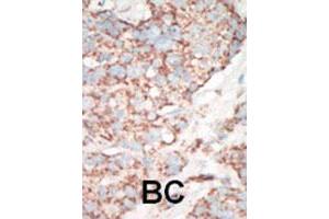 Formalin-fixed and paraffin-embedded human cancer tissue reacted with STK25 polyclonal antibody  , which was peroxidase-conjugated to the secondary antibody, followed by AEC staining. (STK25 Antikörper  (C-Term))