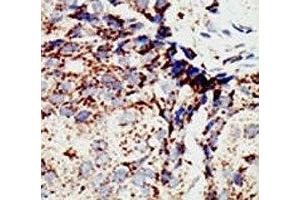 IHC analysis of FFPE human breast carcinoma tissue stained with the BAP1 antibody (BAP1 Antikörper  (AA 36-66))