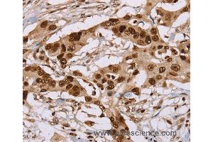 Immunohistochemistry of Human colon cancer using NUP50 Polyclonal Antibody at dilution of 1:30 (NUP50 Antikörper)