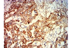 Immunohistochemical analysis of paraffin-embedded rectal cancer tissues using CTNNB1 mouse mAb with DAB staining. (CTNNB1 Antikörper  (AA 632-781))