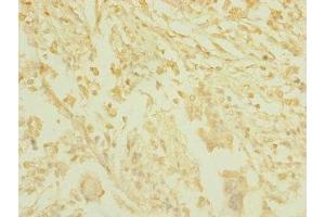 Immunohistochemistry of paraffin-embedded human pancreatic cancer using ABIN7171534 at dilution of 1:100 (TAS1R3 Antikörper  (AA 400-570))