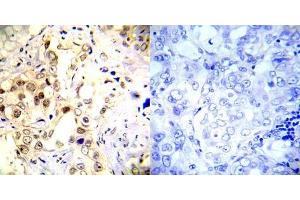 Immunohistochemical analysis of paraffin-embedded human breast carcinoma tissue using P53 (phospho- Ser20) antibody (E012030). (p53 Antikörper  (pSer20))